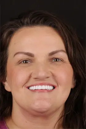 Natural and vibrant smile of a patient after esthetic crown lengthening procedure.